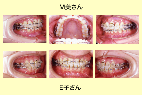 患者OGインタビュー