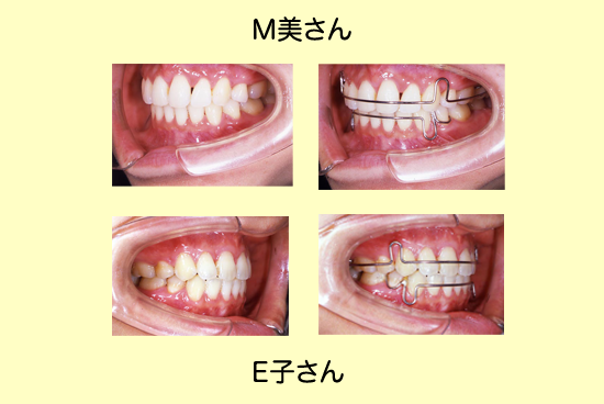 患者OGインタビュー