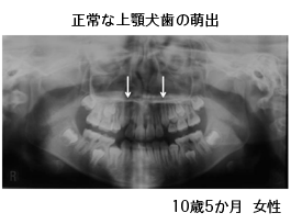 顎骨の中で生える準備をしている上あごの犬歯（問題のない例）