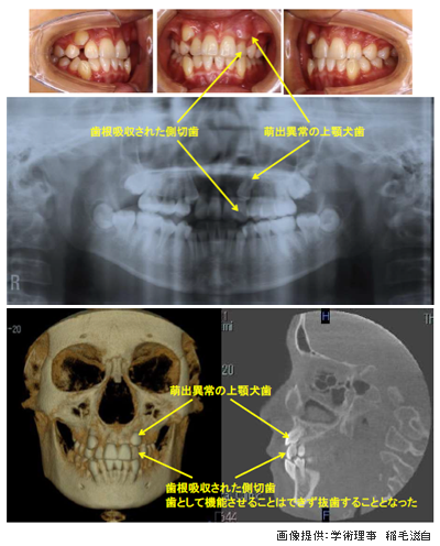 上あごの犬歯によって切歯が歯根吸収された例