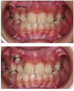 上あごの犬歯による切歯歯根吸収のリスクを回避した例
