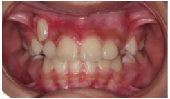 上あごの犬歯による切歯歯根吸収のリスクを回避した例