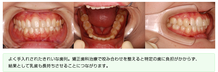 ●現在の歯並び