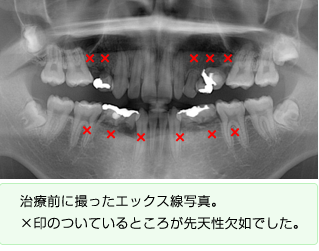第2期治療前に撮ったエックス線写真