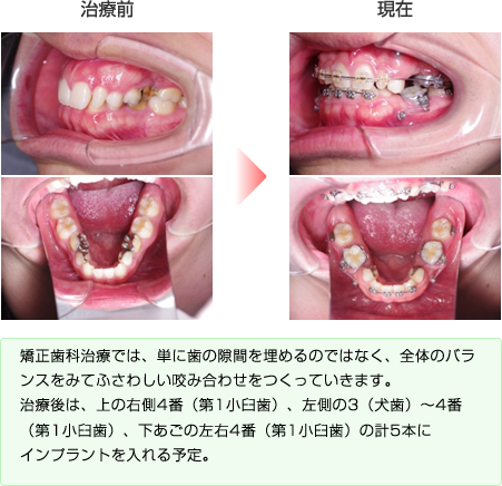 治療前と現在の歯並び