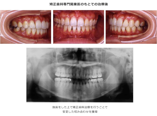 矯正歯科専門開業医のもとでの治療後