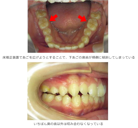 「あごは広げられる」の誤解を知っておこう