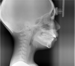 頭部X線規格写真（セファログラム）の撮影