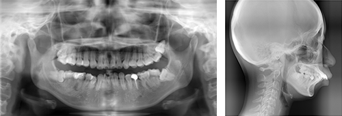 矯正歯科での頭部X線規格写真検査