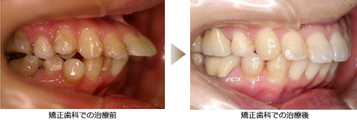 矯正歯科での治療後