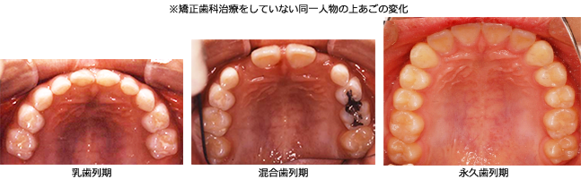 あごの成長変化