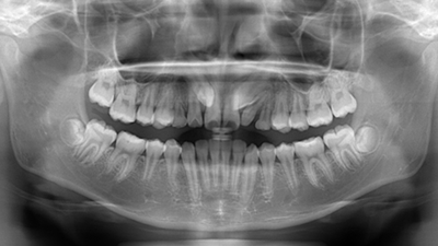 矯正歯科専門歯科医院を受診した際のパノラマエックス線写真