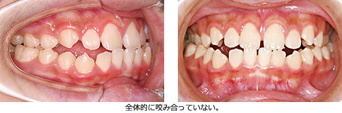 拡大床使用中（12歳8か月）の歯列状態