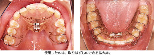 上顎 拡大 装置