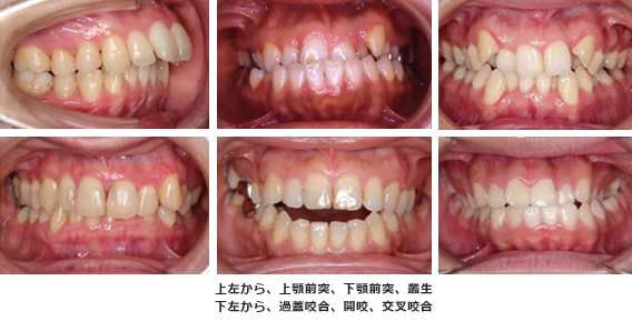 上左から、上顎前突、下顎前突、叢生
