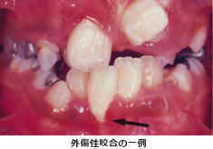 外傷性咬合の一例