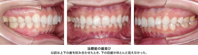 以前は上下の歯を咬み合せたとき、下の前歯がほとんど見えなかった。