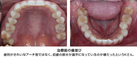 歯列がきれいなアーチ型ではなく、前歯の部分が扁平になっているのが嫌だったというKさん。