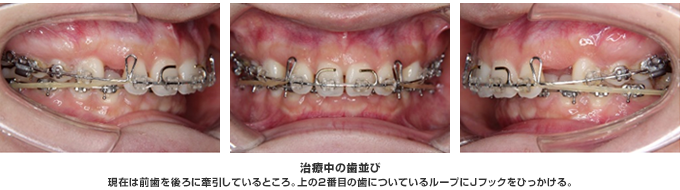 現在は前歯を後ろに牽引しているところ。上の２番目の歯についているループにJフックをひっかける。