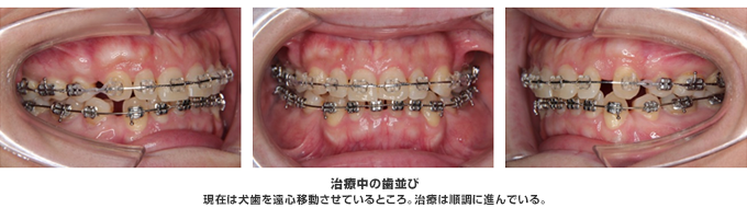 現在は犬歯を遠心移動させているところ。治療は順調に進んでいる。