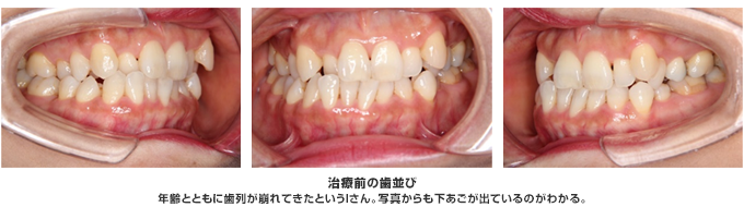 年齢とともに歯列が崩れてきたというIさん。写真からも下あごが出ているのがわかる。