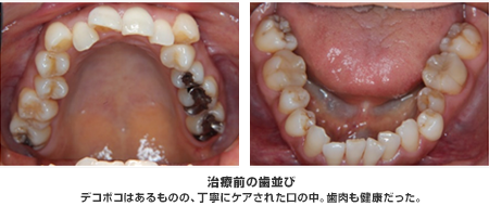 デコボコはあるものの、丁寧にケアされた口の中。歯肉も健康だった。