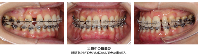 時間をかけてきれいに並んできた歯並び。