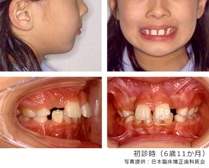 初診時（6歳11か月）
