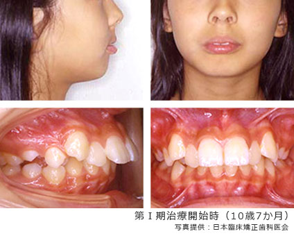 第Ⅰ期治療開始時（10歳7か月）