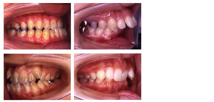 アライナーを用いた治療に不適合