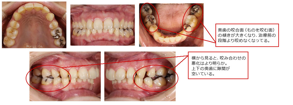 矯正後