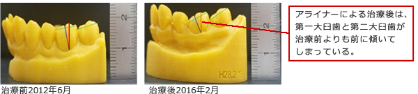 アライナー矯正によって奥歯の傾きが大きくなった
