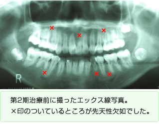 第2期治療前に撮ったエックス線写真