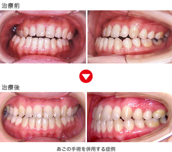 あごの手術を併用する症例