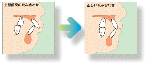 上顎前突(出っ歯)の治療法