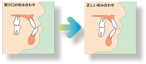 下顎前突(反対咬合・受け口)の治療法