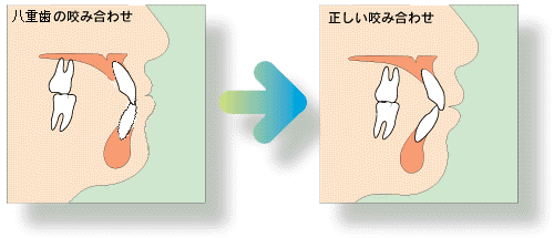 叢生(八重歯など)の治療法