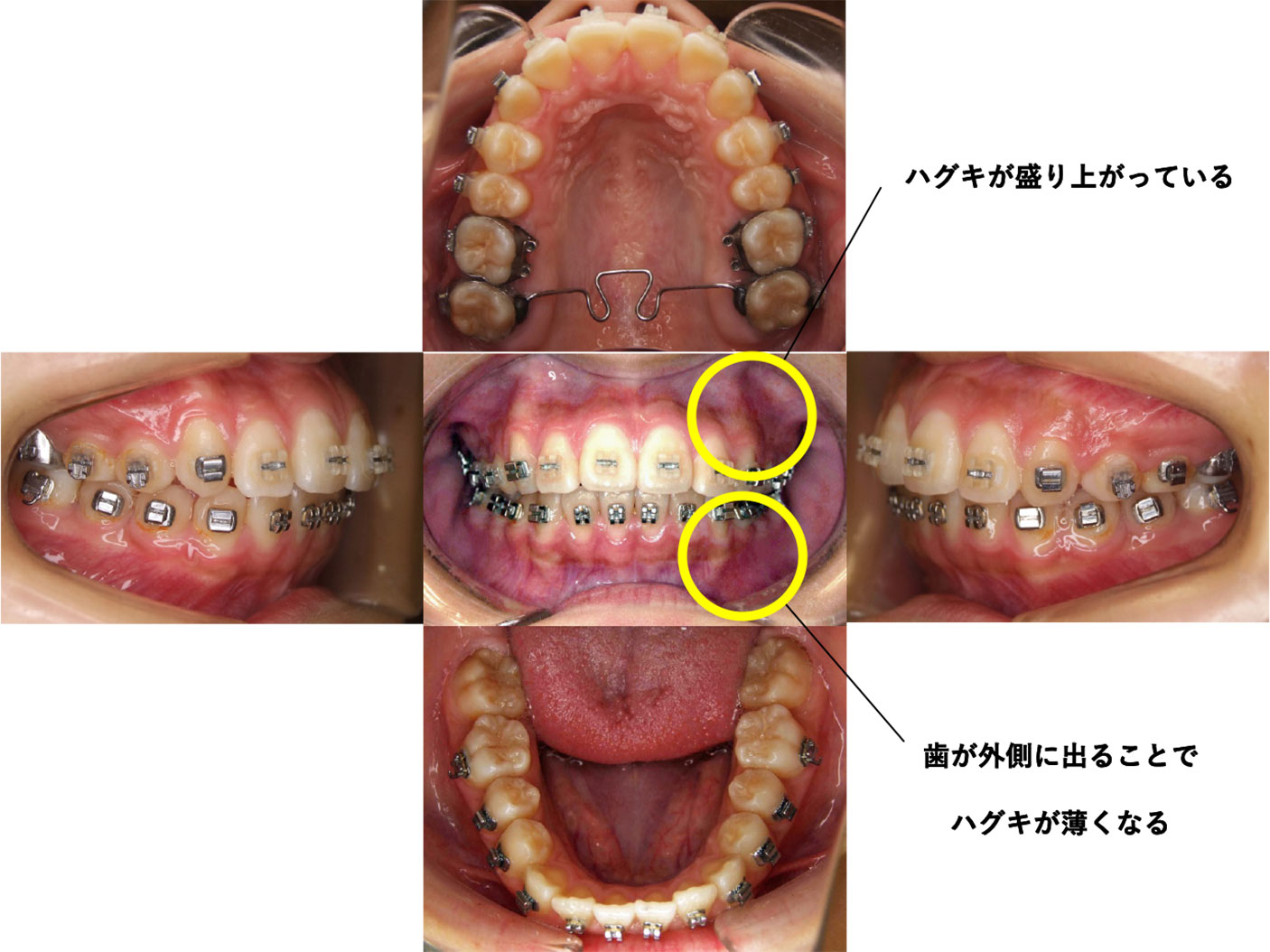 初診時　13歳5か月