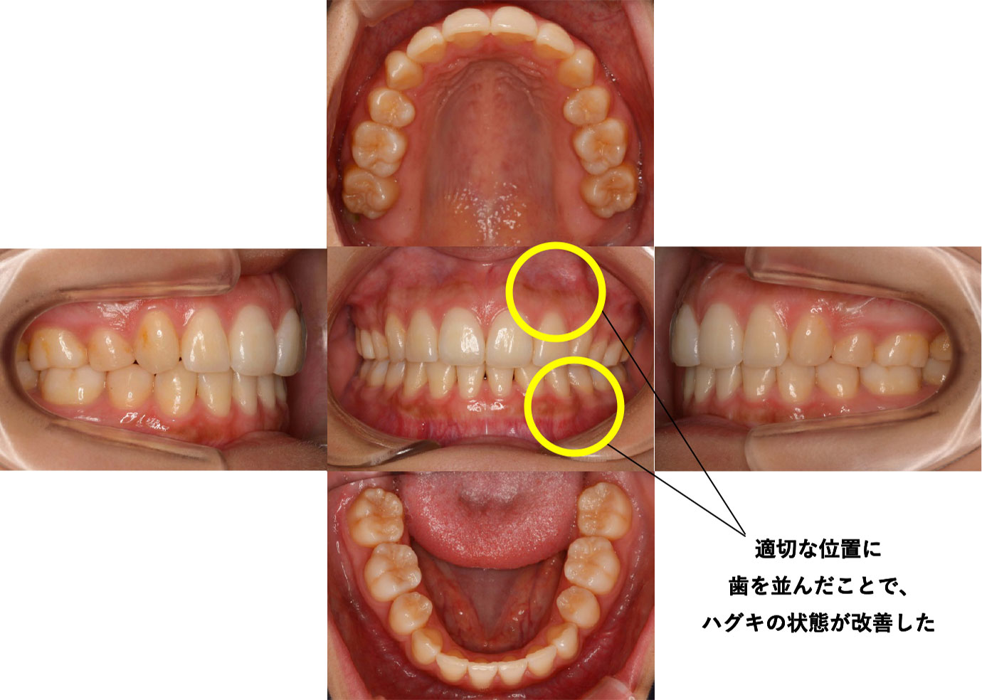 動的治療（2年５か月）終了後