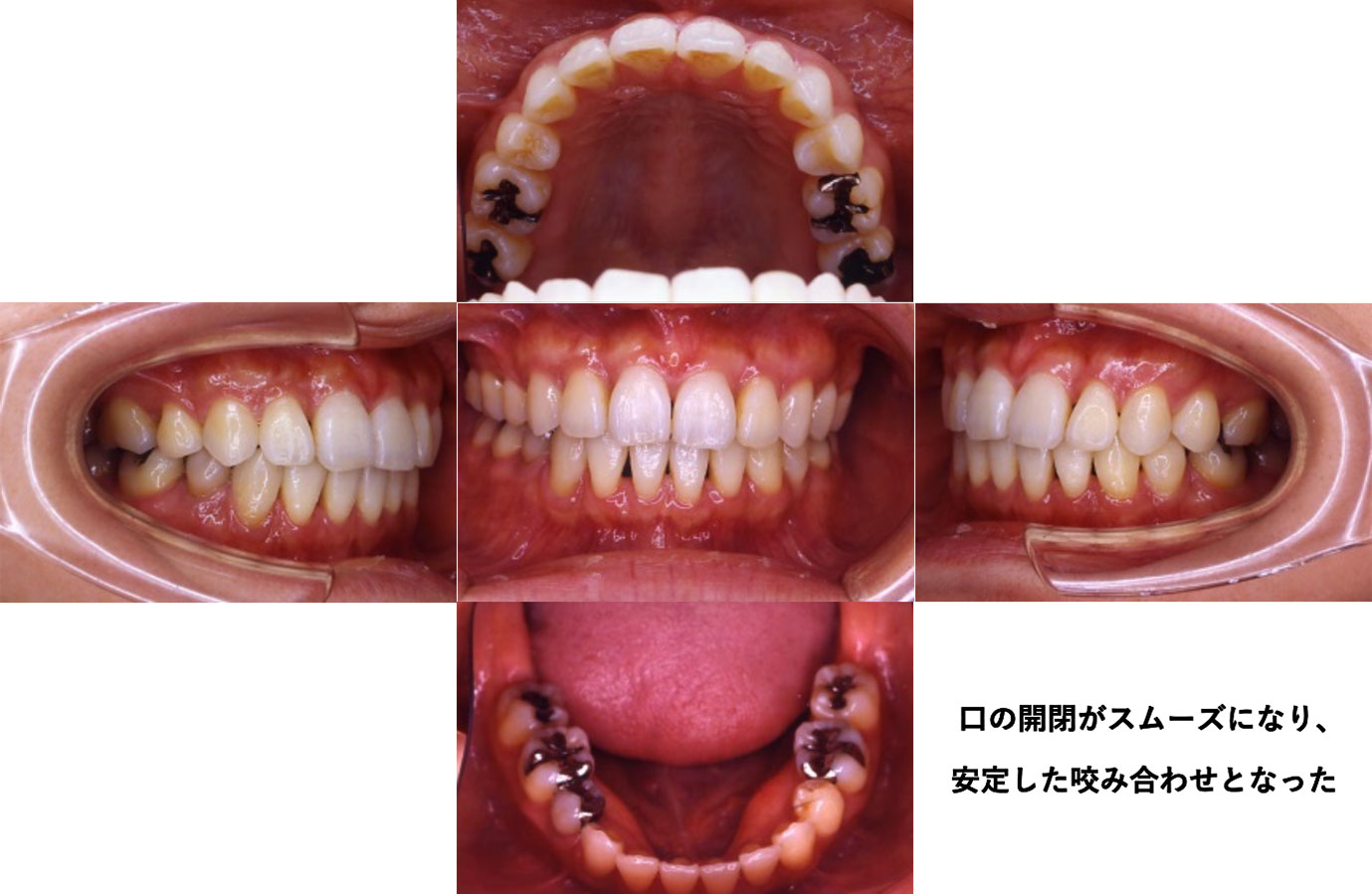 − 動的治療（4年3か月）終了後