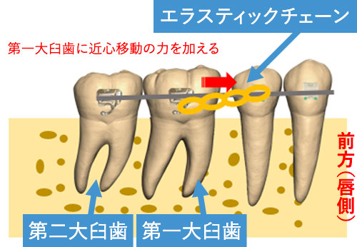 エラスティックチェーンを用いて大臼歯を近心（前方）に移動する場合