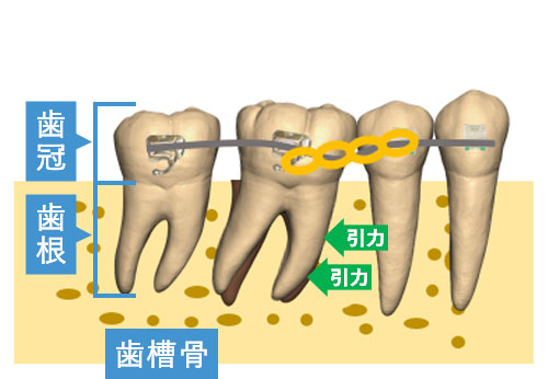 歯槽骨からの反力により歯根の移動は遅れ、まず歯冠（歯肉の上の部分）だけが移動する