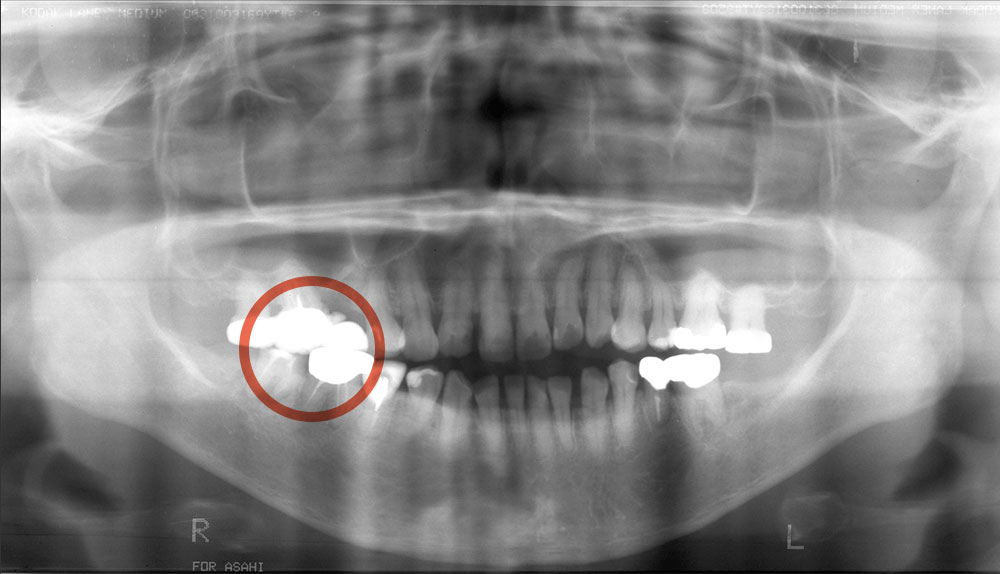 歯は残っているものの、重度の歯周病によって骨が溶けていた