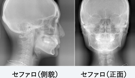 頭部X線規格写真（セファロ）検査