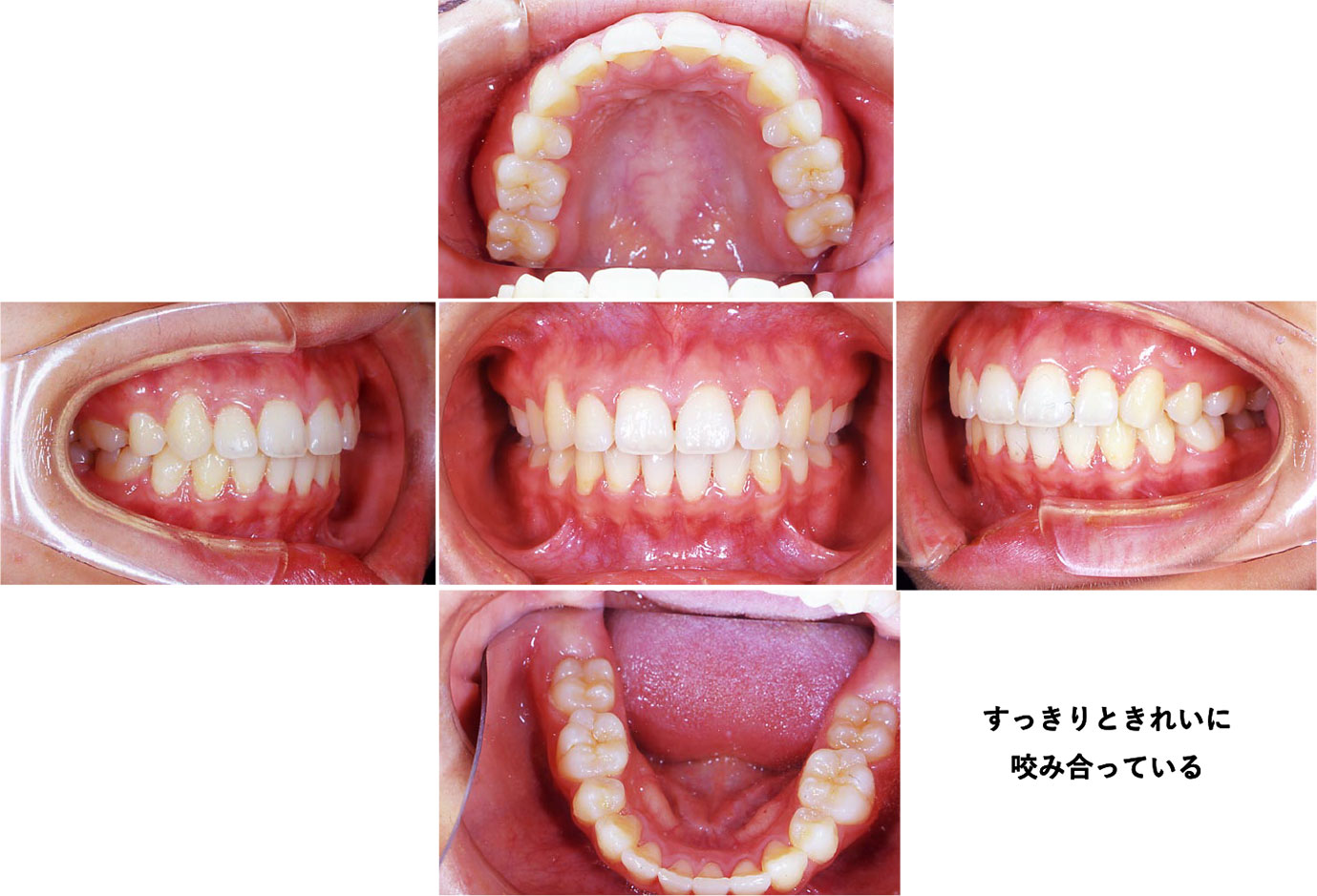 動的治療（3年3か月）終了後