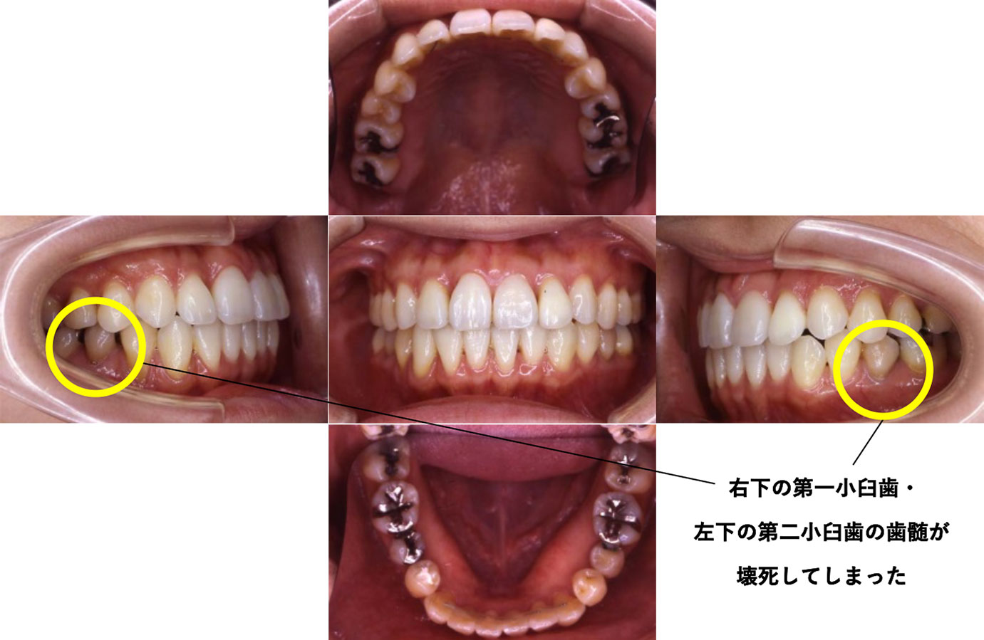 初診時　16歳7か月