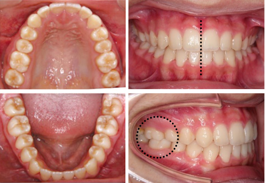 左：上下の歯列がきれいなU字型中：中心線（正中線）が一致右：犬歯より奥の歯が1歯対2歯で噛み合っている
