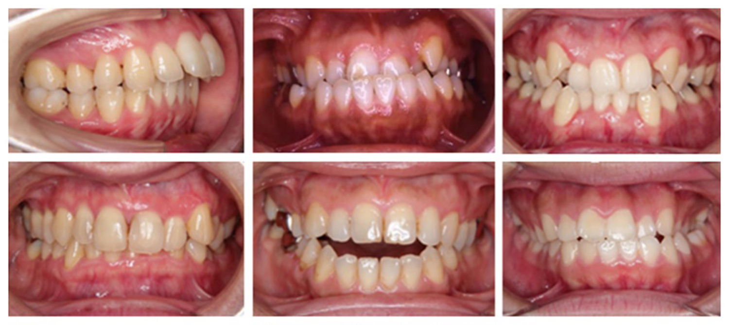 上左から、上顎前突、下顎前突、叢生 下左から、過蓋咬合、開咬、交叉咬合