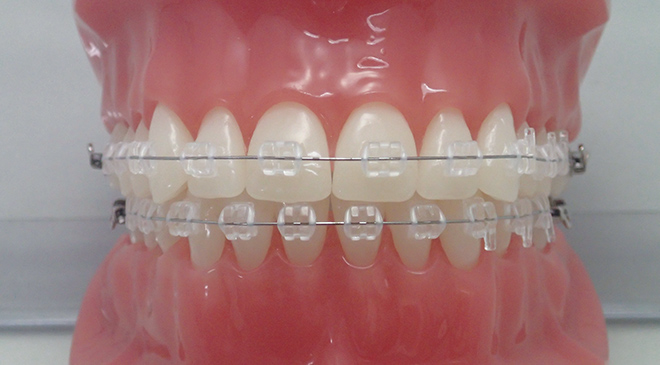 マルチブラケット法では、歯の表面にブラケット（矯正器具）をつけ、その溝にアーチワイヤーを組み込み、歯を3次元的に移動させる 