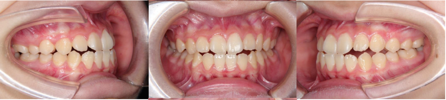 矯正歯科の初診時（13歳10か月）